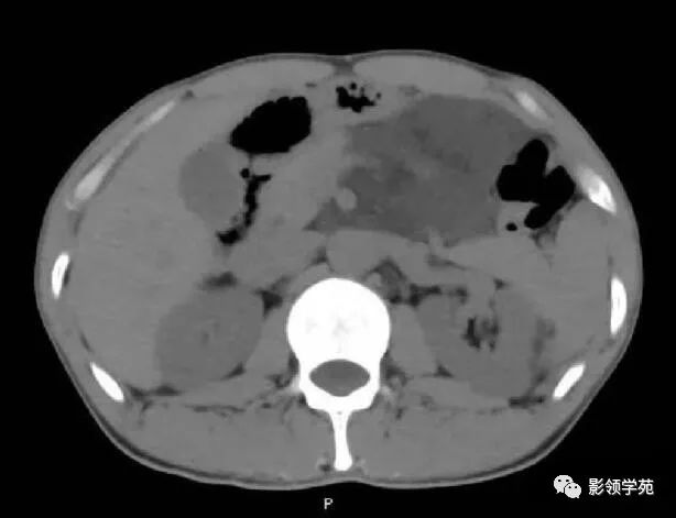 影像PPT - 【病例】腹腔脉管瘤1例CT影像-2 影像PPT - 【病例】腹腔脉管瘤1例CT影像-2