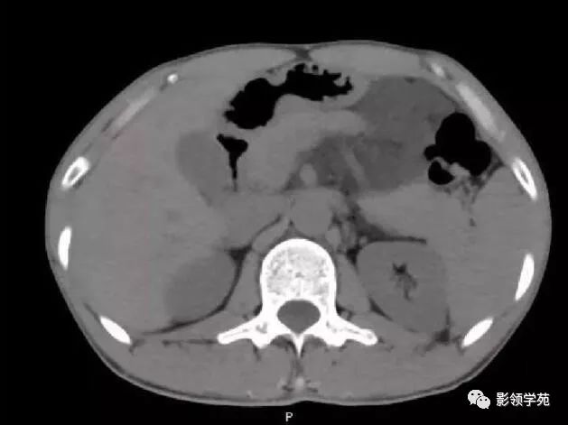 影像PPT - 【病例】腹腔脉管瘤1例CT影像-1 影像PPT - 【病例】腹腔脉管瘤1例CT影像-1
