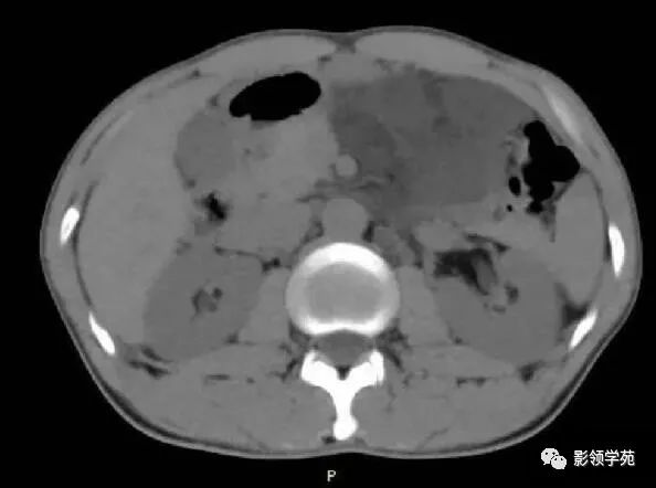 影像PPT - 【病例】腹腔脉管瘤1例CT影像-3 影像PPT - 【病例】腹腔脉管瘤1例CT影像-3