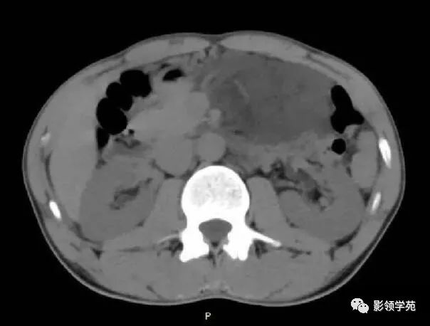 影像PPT - 【病例】腹腔脉管瘤1例CT影像-4 影像PPT - 【病例】腹腔脉管瘤1例CT影像-4