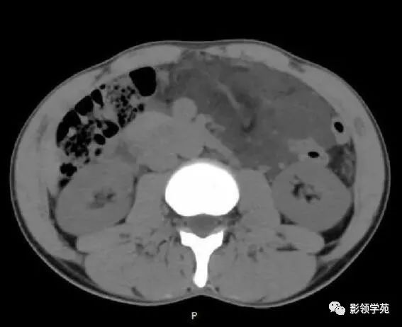 影像PPT - 【病例】腹腔脉管瘤1例CT影像-6 影像PPT - 【病例】腹腔脉管瘤1例CT影像-6