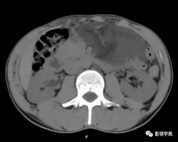 影像PPT - 【病例】腹腔脉管瘤1例CT影像-5 影像PPT - 【病例】腹腔脉管瘤1例CT影像-5