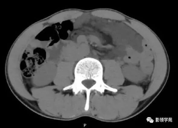 影像PPT - 【病例】腹腔脉管瘤1例CT影像-8 影像PPT - 【病例】腹腔脉管瘤1例CT影像-8