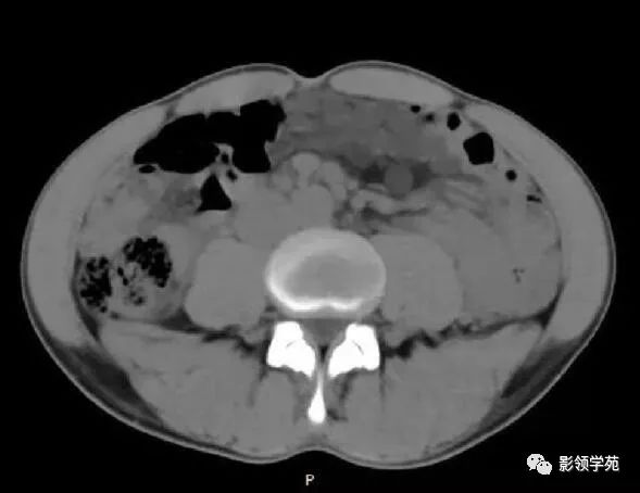 影像PPT - 【病例】腹腔脉管瘤1例CT影像-10 影像PPT - 【病例】腹腔脉管瘤1例CT影像-10