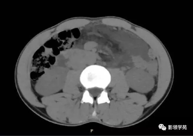 影像PPT - 【病例】腹腔脉管瘤1例CT影像-7 影像PPT - 【病例】腹腔脉管瘤1例CT影像-7