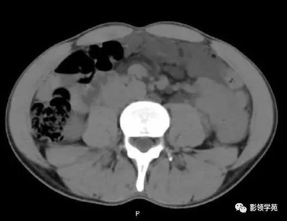 影像PPT - 【病例】腹腔脉管瘤1例CT影像-9 影像PPT - 【病例】腹腔脉管瘤1例CT影像-9