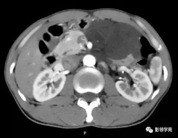 影像PPT - 【病例】腹腔脉管瘤1例CT影像-13 影像PPT - 【病例】腹腔脉管瘤1例CT影像-13