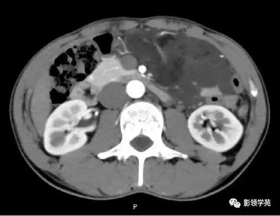 影像PPT - 【病例】腹腔脉管瘤1例CT影像-15 影像PPT - 【病例】腹腔脉管瘤1例CT影像-15