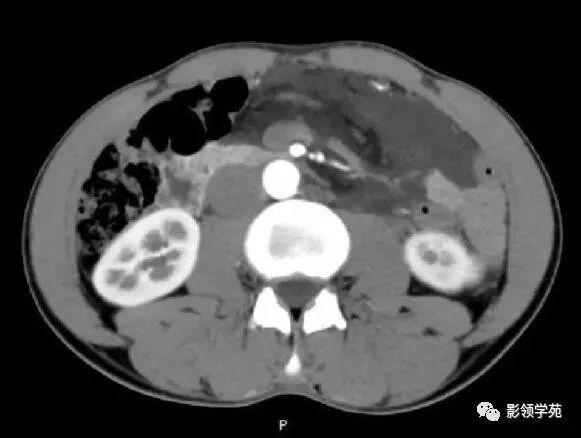 影像PPT - 【病例】腹腔脉管瘤1例CT影像-17 影像PPT - 【病例】腹腔脉管瘤1例CT影像-17