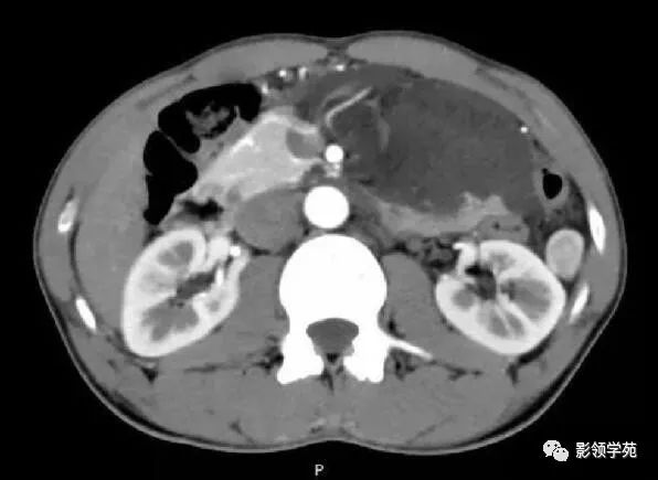 影像PPT - 【病例】腹腔脉管瘤1例CT影像-14 影像PPT - 【病例】腹腔脉管瘤1例CT影像-14