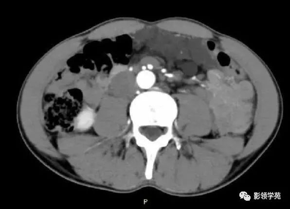 影像PPT - 【病例】腹腔脉管瘤1例CT影像-19 影像PPT - 【病例】腹腔脉管瘤1例CT影像-19