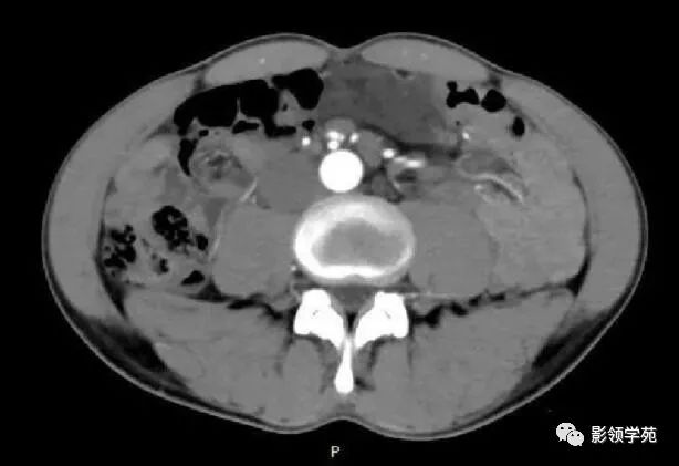 影像PPT - 【病例】腹腔脉管瘤1例CT影像-20 影像PPT - 【病例】腹腔脉管瘤1例CT影像-20