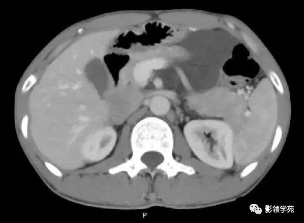 影像PPT - 【病例】腹腔脉管瘤1例CT影像-21 影像PPT - 【病例】腹腔脉管瘤1例CT影像-21