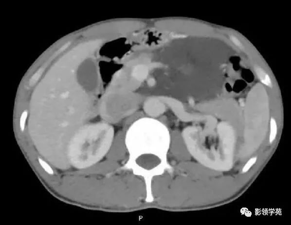 影像PPT - 【病例】腹腔脉管瘤1例CT影像-22 影像PPT - 【病例】腹腔脉管瘤1例CT影像-22