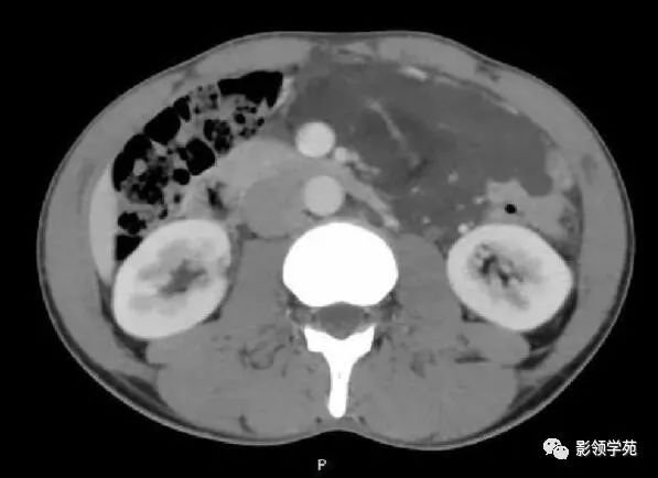 影像PPT - 【病例】腹腔脉管瘤1例CT影像-26 影像PPT - 【病例】腹腔脉管瘤1例CT影像-26