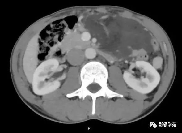 影像PPT - 【病例】腹腔脉管瘤1例CT影像-25 影像PPT - 【病例】腹腔脉管瘤1例CT影像-25