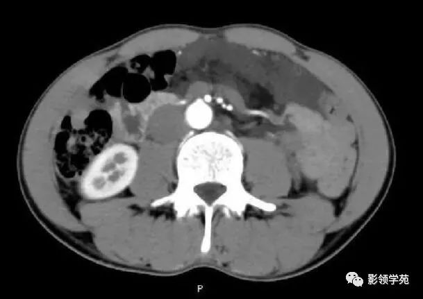 影像PPT - 【病例】腹腔脉管瘤1例CT影像-18 影像PPT - 【病例】腹腔脉管瘤1例CT影像-18
