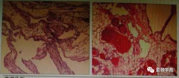 影像PPT - 【病例】腹腔脉管瘤1例CT影像-31 影像PPT - 【病例】腹腔脉管瘤1例CT影像-31