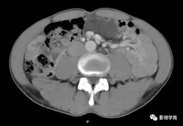 影像PPT - 【病例】腹腔脉管瘤1例CT影像-30 影像PPT - 【病例】腹腔脉管瘤1例CT影像-30