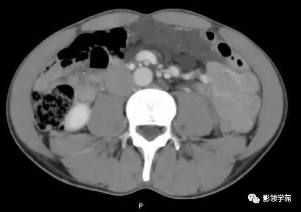 影像PPT - 【病例】腹腔脉管瘤1例CT影像-29 影像PPT - 【病例】腹腔脉管瘤1例CT影像-29