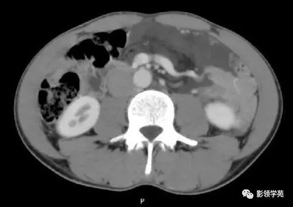 影像PPT - 【病例】腹腔脉管瘤1例CT影像-28 影像PPT - 【病例】腹腔脉管瘤1例CT影像-28