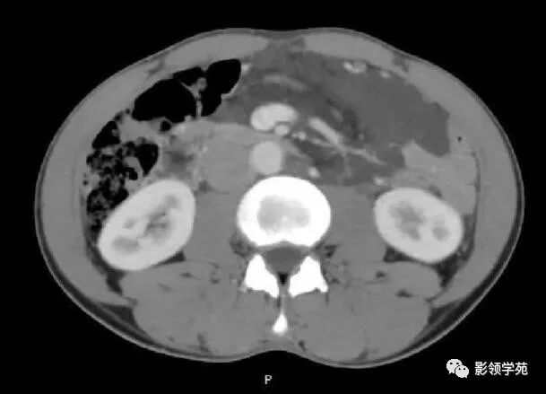 影像PPT - 【病例】腹腔脉管瘤1例CT影像-27 影像PPT - 【病例】腹腔脉管瘤1例CT影像-27
