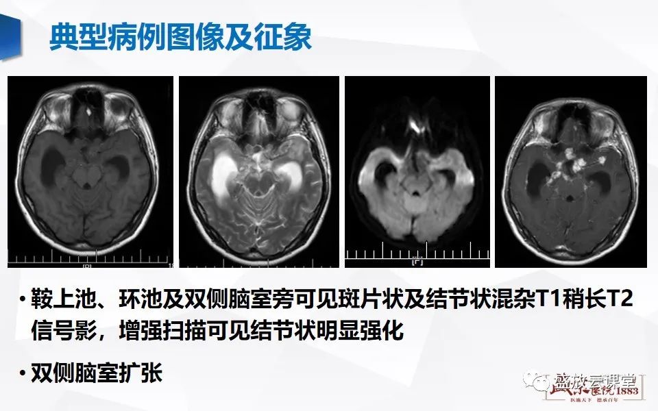 影像PPT - 【PPT】神经系统特殊感染（脑结核及脑囊虫病）-5