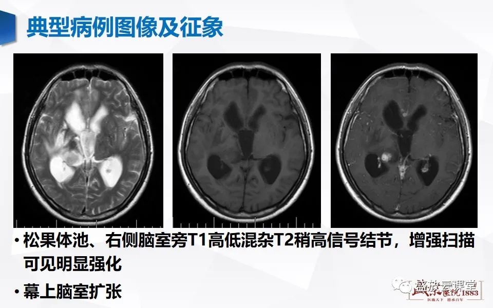 影像PPT - 【PPT】神经系统特殊感染（脑结核及脑囊虫病）-6
