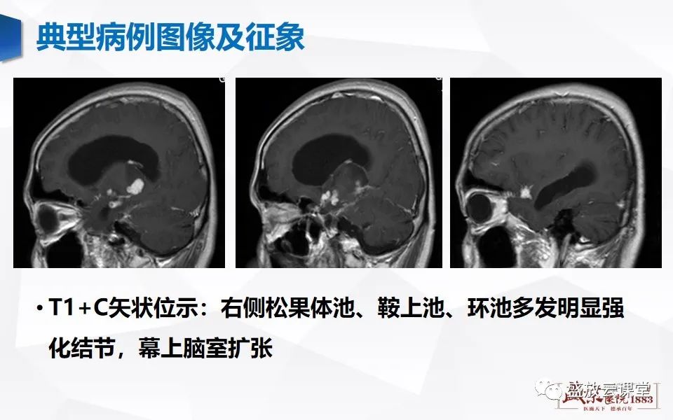 影像PPT - 【PPT】神经系统特殊感染（脑结核及脑囊虫病）-7