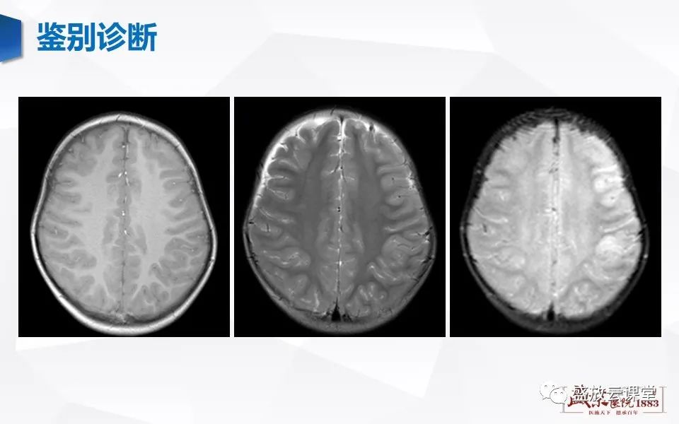 影像PPT - 【PPT】神经系统特殊感染（脑结核及脑囊虫病）-13