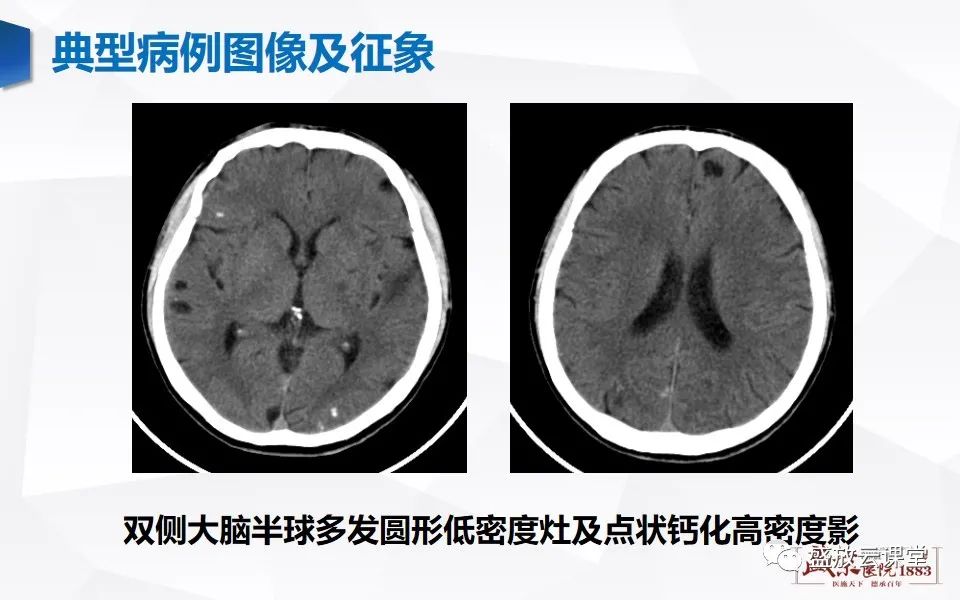 影像PPT - 【PPT】神经系统特殊感染（脑结核及脑囊虫病）-19