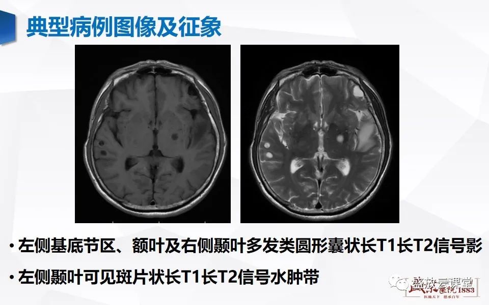 影像PPT - 【PPT】神经系统特殊感染（脑结核及脑囊虫病）-21