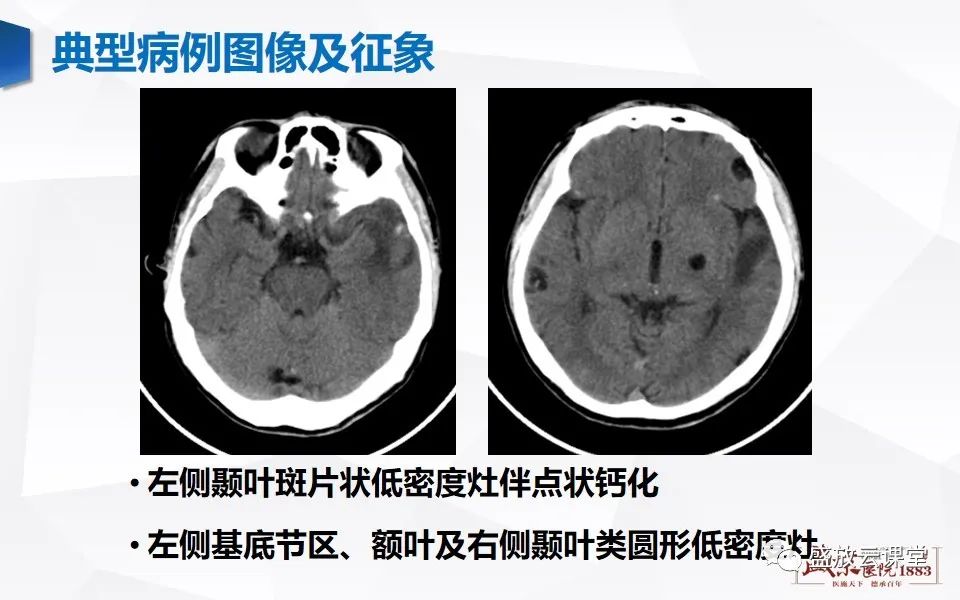 影像PPT - 【PPT】神经系统特殊感染（脑结核及脑囊虫病）-18