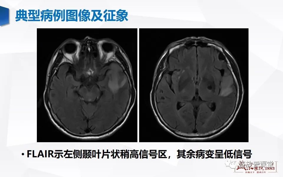 影像PPT - 【PPT】神经系统特殊感染（脑结核及脑囊虫病）-23