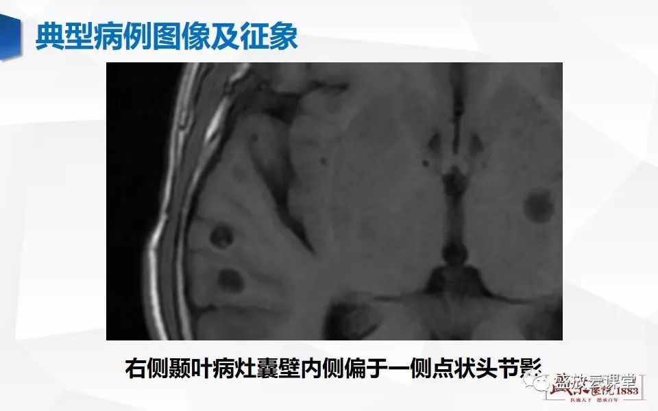 影像PPT - 【PPT】神经系统特殊感染（脑结核及脑囊虫病）-22