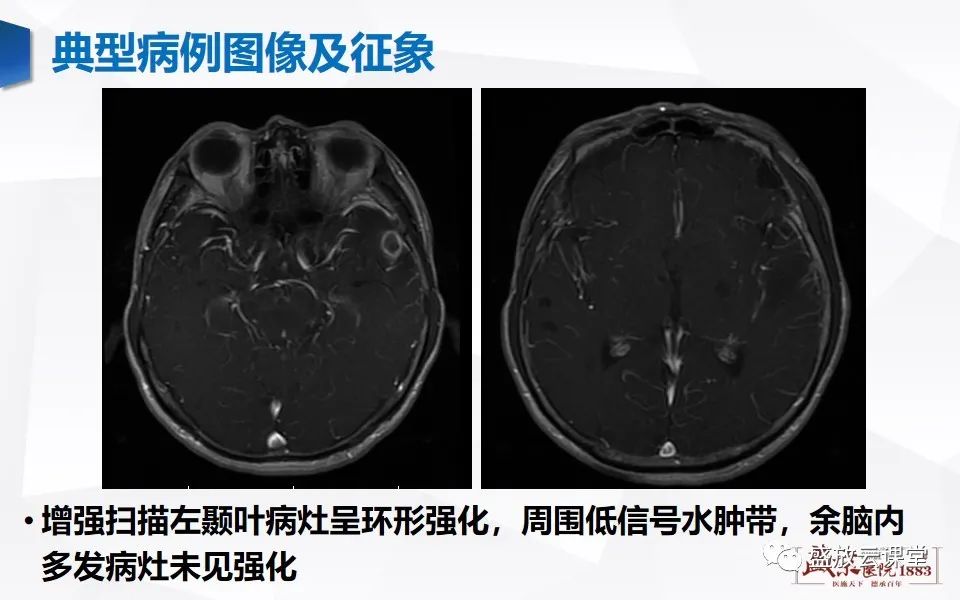 影像PPT - 【PPT】神经系统特殊感染（脑结核及脑囊虫病）-24