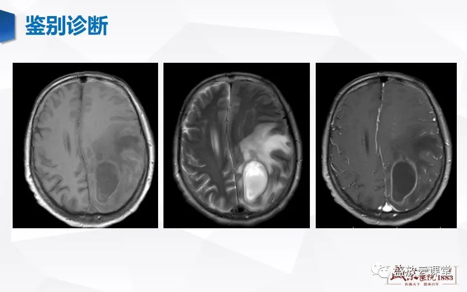 影像PPT - 【PPT】神经系统特殊感染（脑结核及脑囊虫病）-30