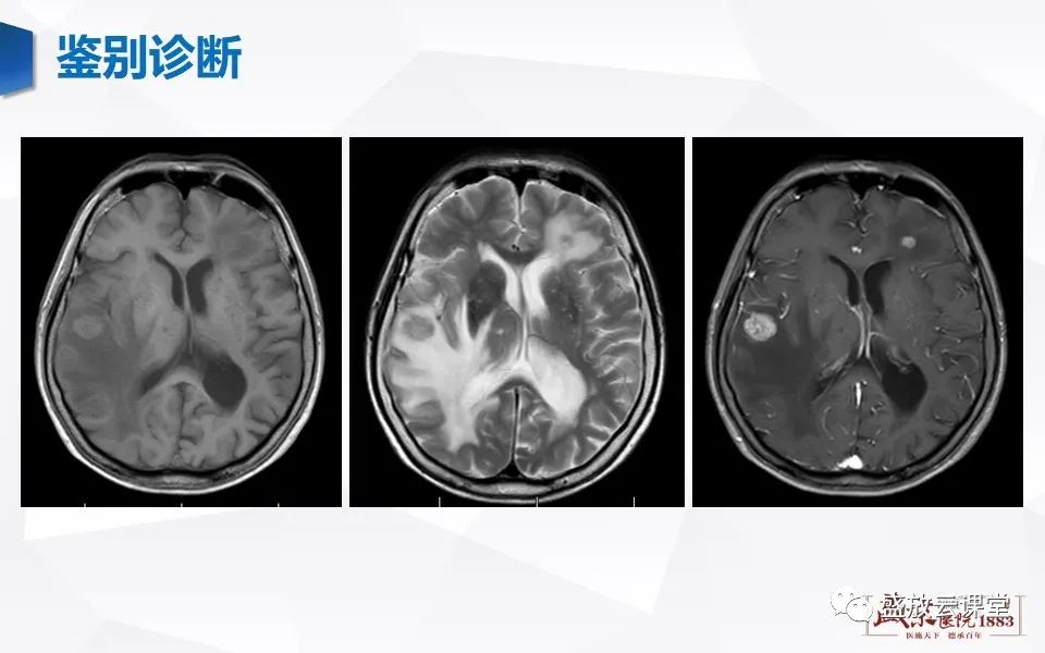 影像PPT - 【PPT】神经系统特殊感染（脑结核及脑囊虫病）-32