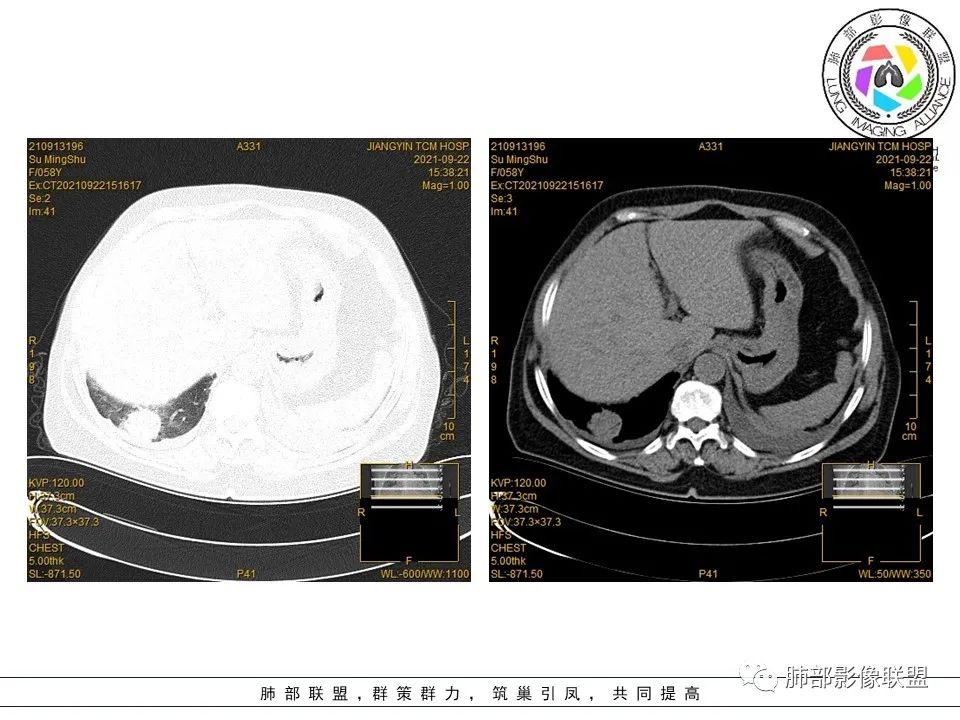 影像PPT - 【病例】罕见的急性纤维素机化性肺炎AFOP-41 影像PPT - 【病例】罕见的急性纤维素机化性肺炎AFOP-41