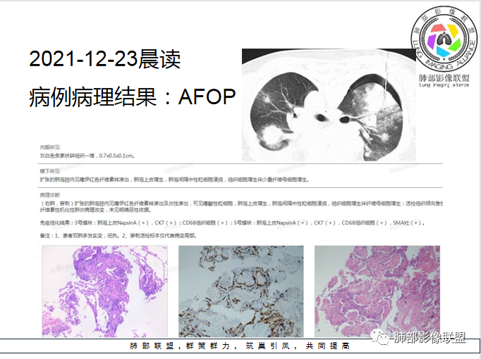 影像PPT - 【病例】罕见的急性纤维素机化性肺炎AFOP-57 影像PPT - 【病例】罕见的急性纤维素机化性肺炎AFOP-57