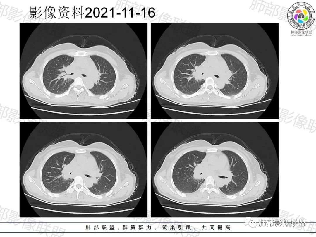 影像PPT - 【病例】诡异多变的结核-6 影像PPT - 【病例】诡异多变的结核-6