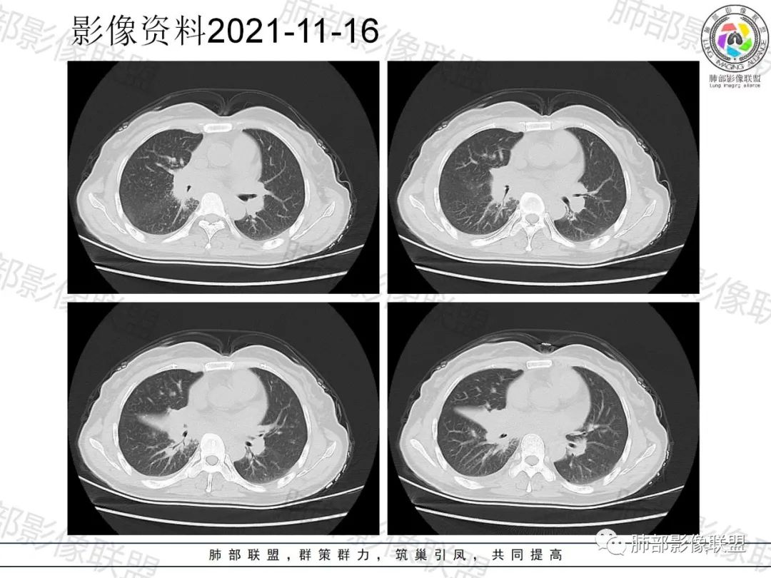 影像PPT - 【病例】诡异多变的结核-7 影像PPT - 【病例】诡异多变的结核-7