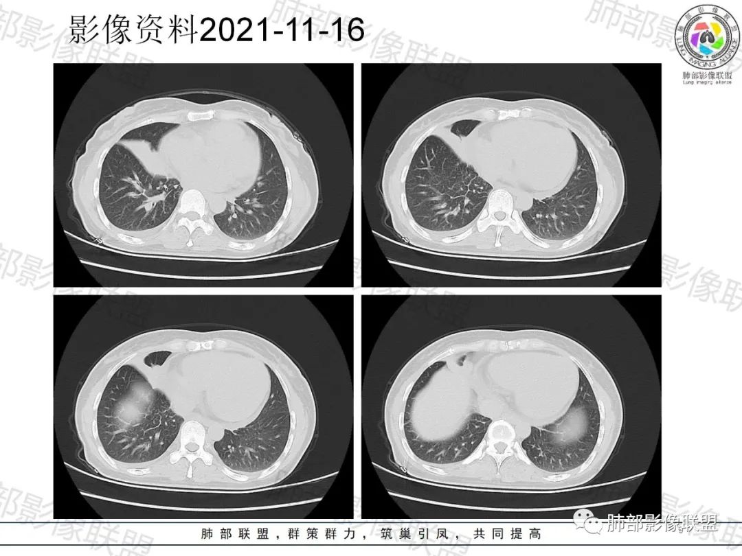 影像PPT - 【病例】诡异多变的结核-9 影像PPT - 【病例】诡异多变的结核-9