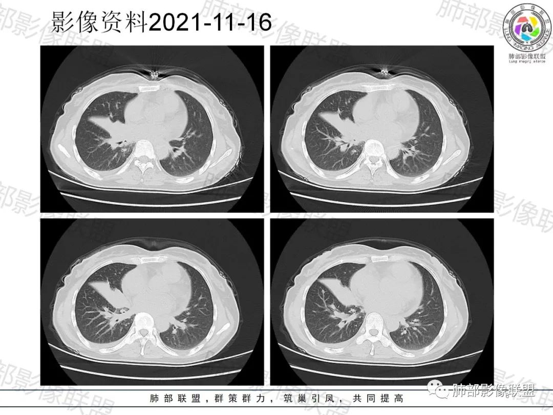影像PPT - 【病例】诡异多变的结核-8 影像PPT - 【病例】诡异多变的结核-8