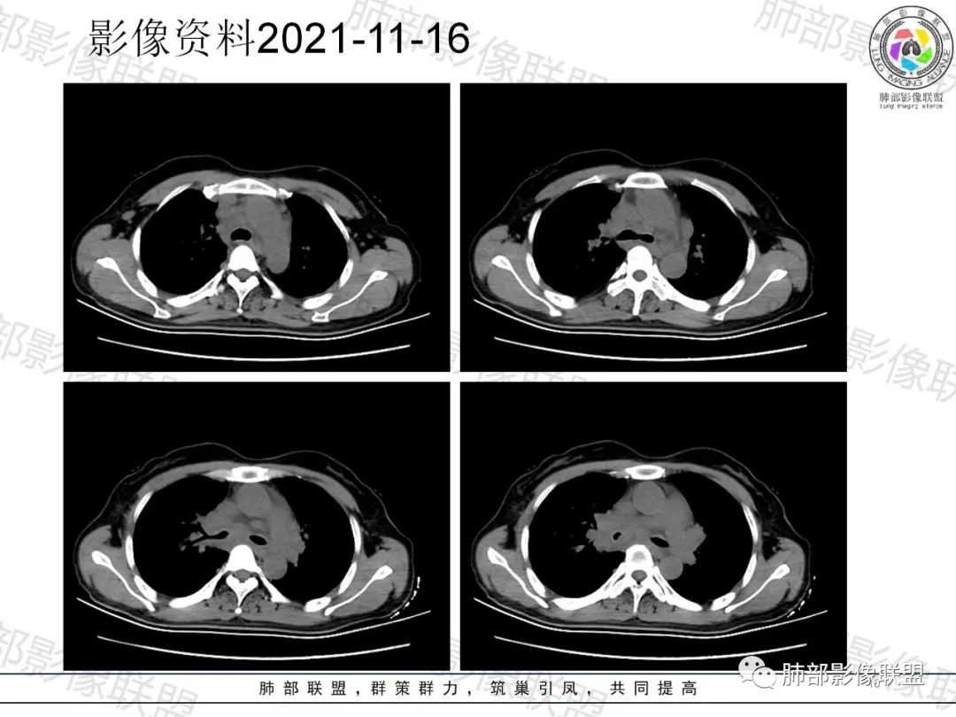 影像PPT - 【病例】诡异多变的结核-10 影像PPT - 【病例】诡异多变的结核-10