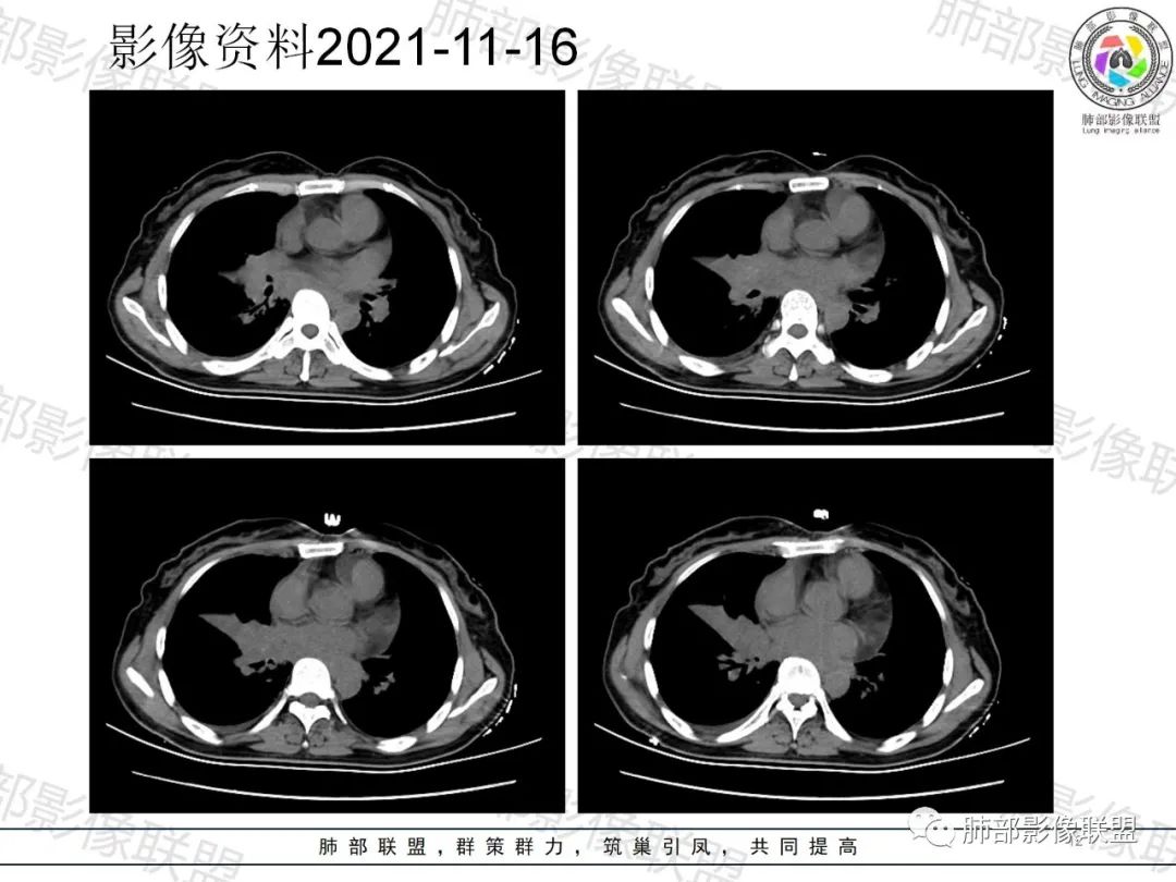 影像PPT - 【病例】诡异多变的结核-12 影像PPT - 【病例】诡异多变的结核-12