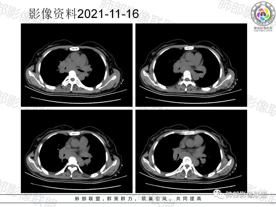 影像PPT - 【病例】诡异多变的结核-11 影像PPT - 【病例】诡异多变的结核-11