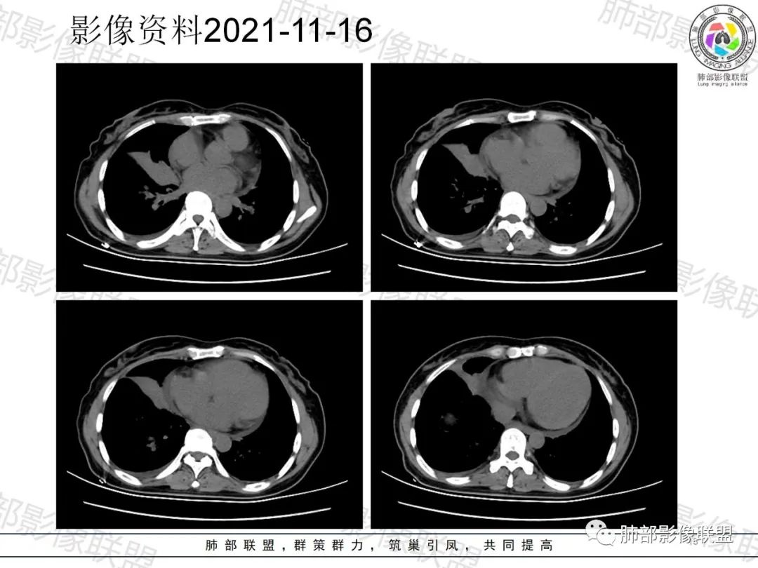 影像PPT - 【病例】诡异多变的结核-13 影像PPT - 【病例】诡异多变的结核-13