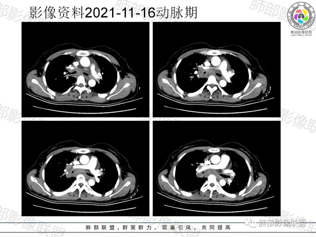 影像PPT - 【病例】诡异多变的结核-15 影像PPT - 【病例】诡异多变的结核-15