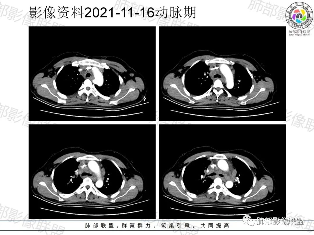 影像PPT - 【病例】诡异多变的结核-14 影像PPT - 【病例】诡异多变的结核-14